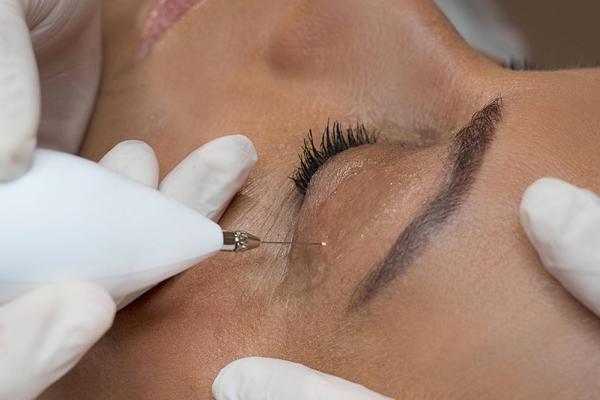 Kaltes Plasma in der Kosmetik